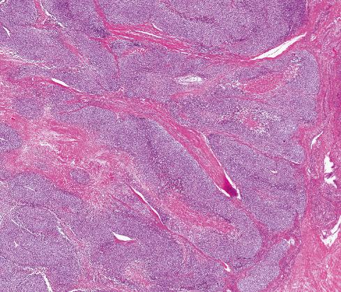 Fig. 33.19, CIC-DUX4 –translocated sarcoma with central area of necrosis surrounded by malignant round cells.