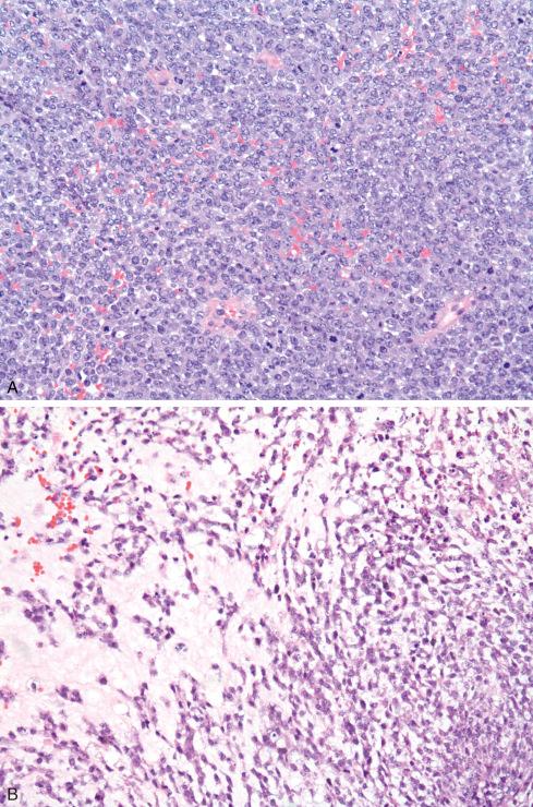 Fig. 33.20, A to D, CIC-DUX4 –translocated sarcoma showing range of patterns.
