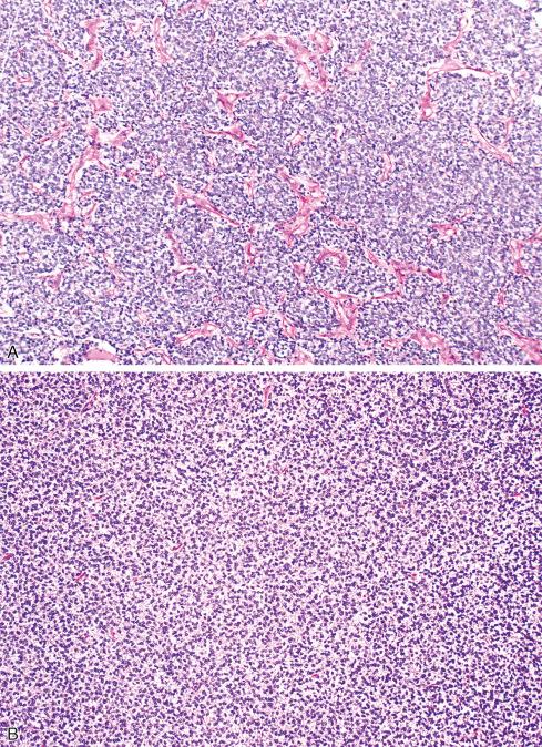 Fig. 33.2, A, Low-power view of extraskeletal Ewing sarcoma characterized by lobular round cell pattern of striking uniformity. B, Typical low-power view of the monotonous appearance of this tumor.