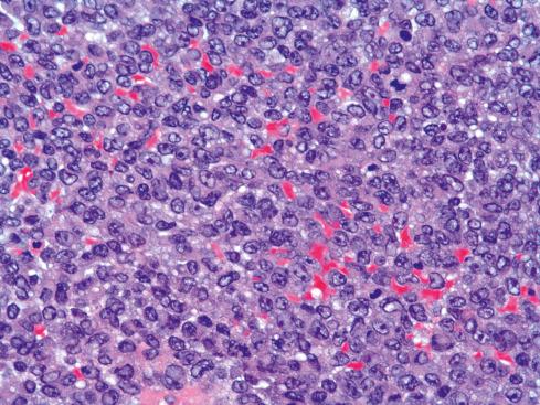 Fig. 33.21, CIC-DUX4 –translocated sarcoma showing sheets of large rounded cells.