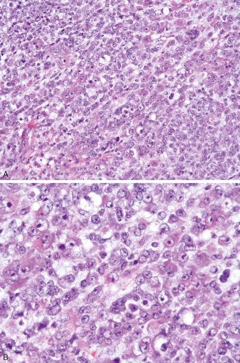 Fig. 33.22, CIC-DUX4 –translocated sarcoma with vesicular nuclei ( A ) and rhabdoid features ( B ).