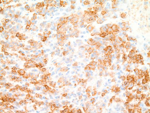 Fig. 33.23, Focal membranous CD99 immunoreactivity in CIC-DUX4 –translocated sarcoma.