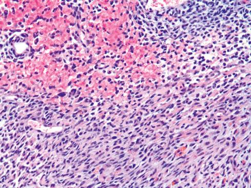 Fig. 33.24, BCOR -rearranged sarcoma.