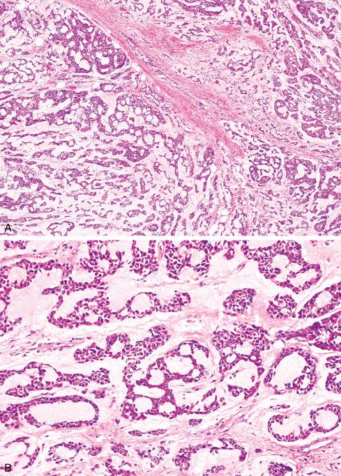 Fig. 33.28, A to C, Extraskeletal myxoid chondrosarcoma. Cords of eosinophilic cells are deposited in an abundant myxoid stroma.