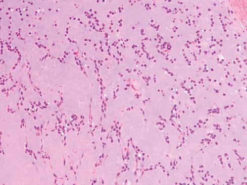 Fig. 33.29, Characteristic alignment of tumor cells in strands and cords separated by large amounts of mucoid material in extraskeletal myxoid chondrosarcoma.