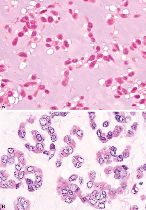 Fig. 33.30, A and B, Extraskeletal myxoid chondrosarcoma composed of cells with thin rim of eosinophilic cytoplasm. Note vacuolization of matrix, a consistent artifact in these tumors.