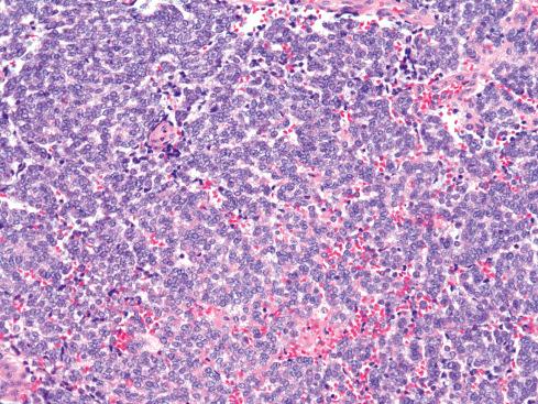 Fig. 33.3, Extraskeletal Ewing sarcoma composed of sheets of relatively uniform round cells.