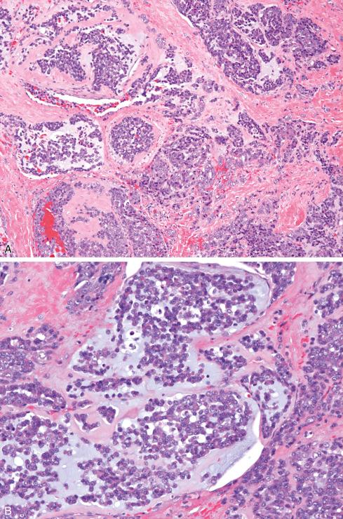 Fig. 33.31, A to C, Cellular variant of extraskeletal myxoid chondrosarcoma composed of large cells with vesicular nuclei and deeply eosinophilic cytoplasm. Other areas of typical myxoid chondrosarcoma were present in this tumor.