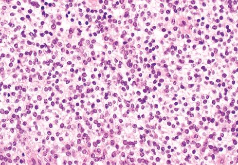 Fig. 33.5, Ewing sarcoma with clear cytoplasm secondary to glycogen deposits.