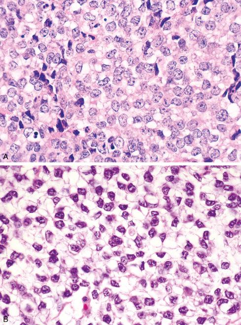 Fig. 33.6, A and B, Cytoplasmic vacuoles secondary to deposition of intracellular glycogen often indent the nuclei in Ewing sarcoma.