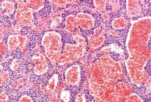 Fig. 33.7, Hemorrhagic zone in extraskeletal Ewing sarcoma resembling a vascular neoplasm.