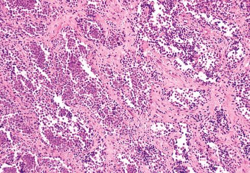 Fig. 33.8, Alveolar pattern in Ewing sarcoma caused by degeneration.