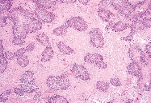Fig. 33.10, Zonal necrosis in Ewing sarcoma.