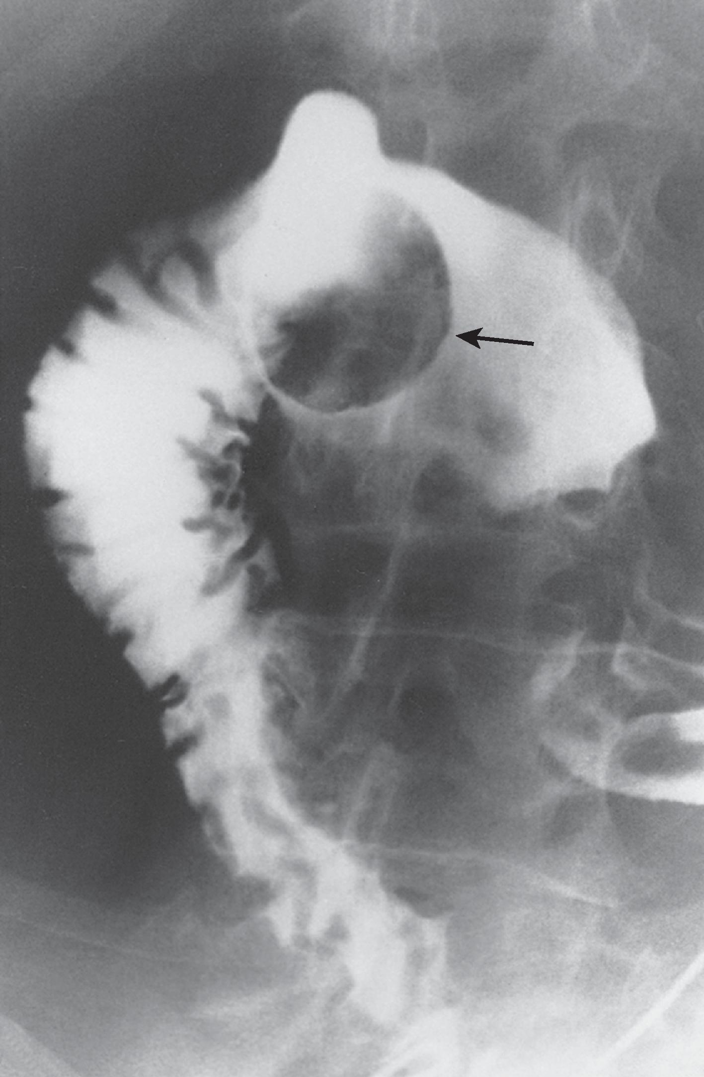 Fig. 21.1, Hematogenous metastasis to the duodenum from malignant melanoma.