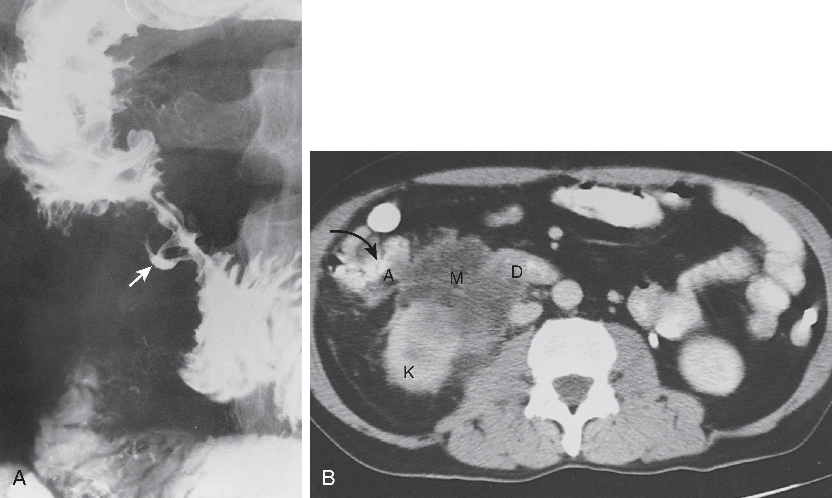 Fig. 21.12, Duodenal invasion by colonic carcinoma.