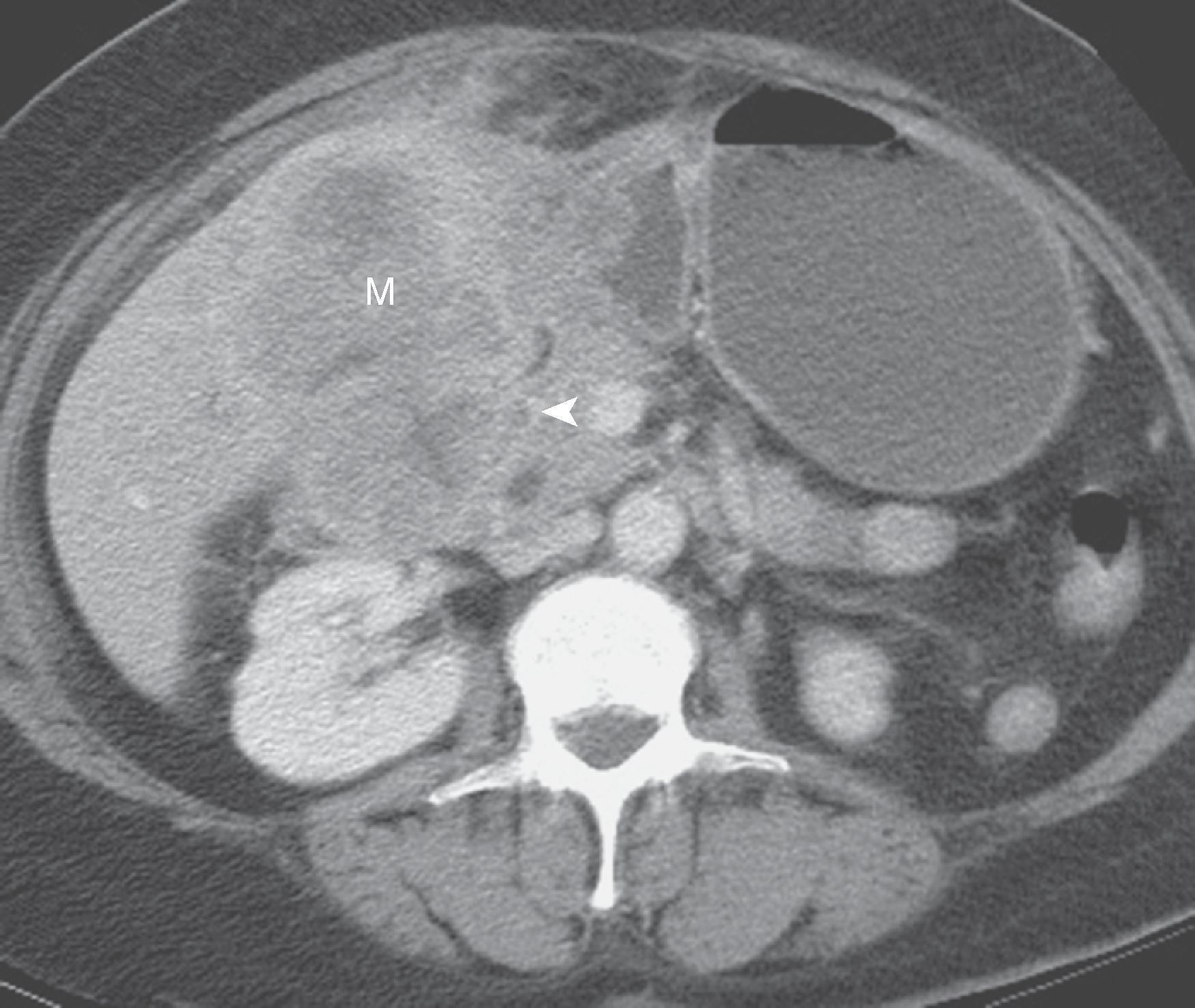 Fig. 21.13, Gallbladder carcinoma invading the stomach and duodenum on computed tomography (CT).