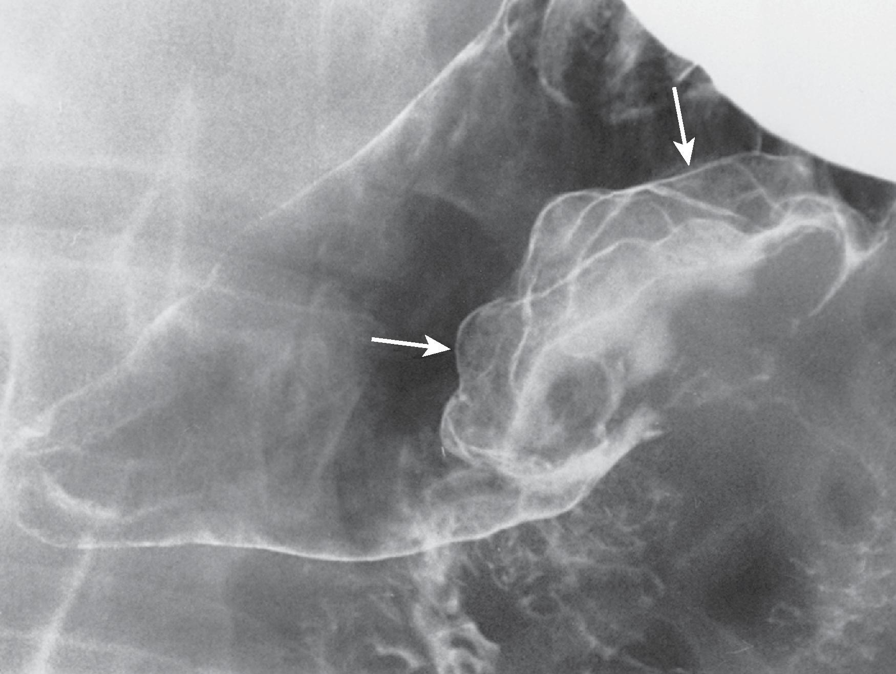 Fig. 21.3, Polypoid gastric metastasis from malignant melanoma.