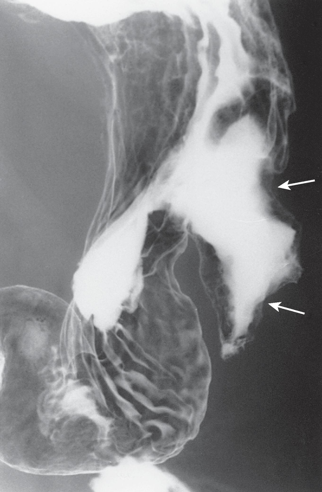 Fig. 21.4, Cavitated gastric metastasis from malignant melanoma.