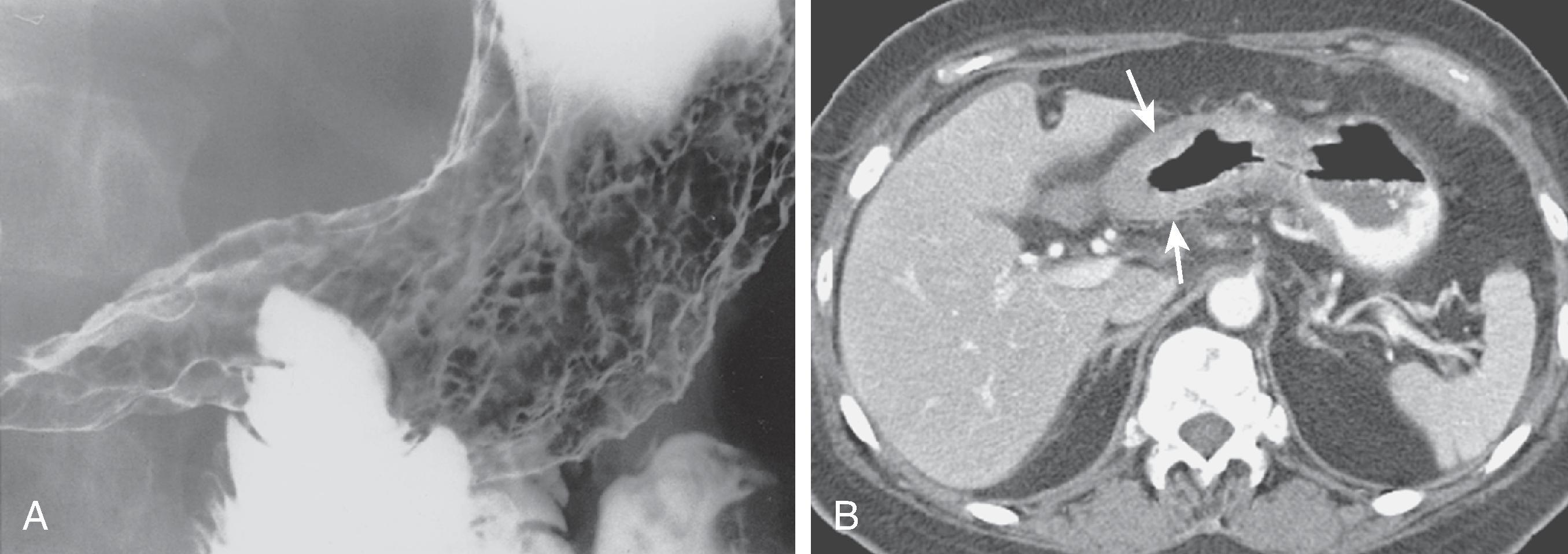 Fig. 21.5, Metastatic breast cancer involving the stomach with a linitis plastica appearance.