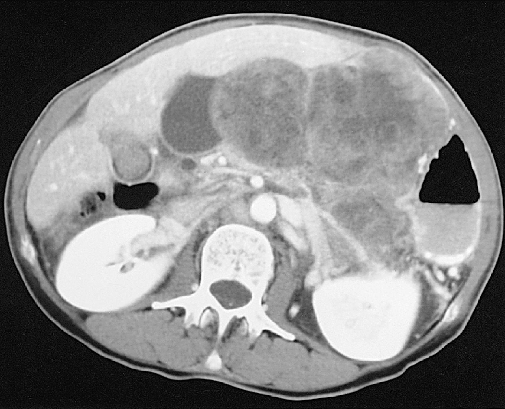 Fig. 21.7, Metastatic adenopathy from squamous cell carcinoma of the esophagus on computed tomography (CT).