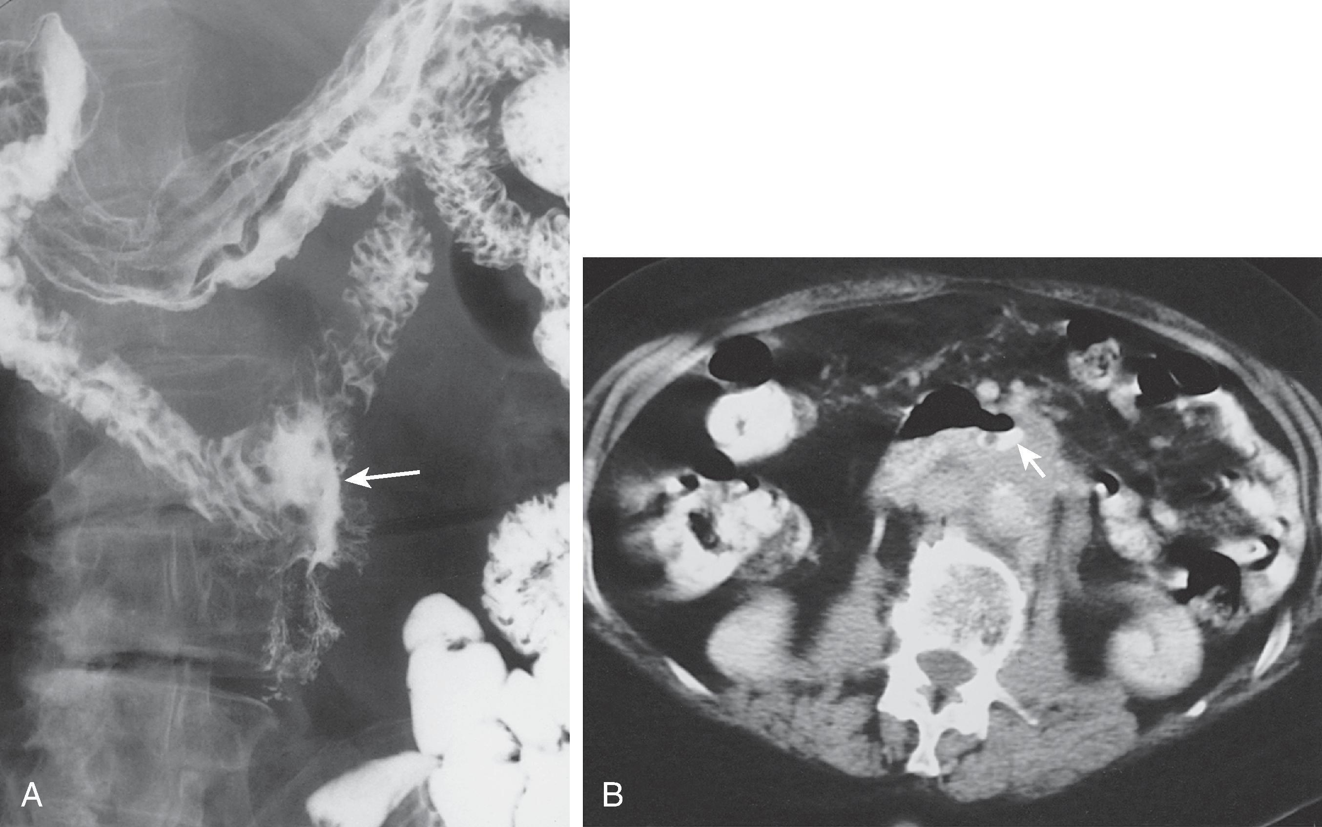 Fig. 21.8, Duodenal invasion by retroperitoneal adenopathy.