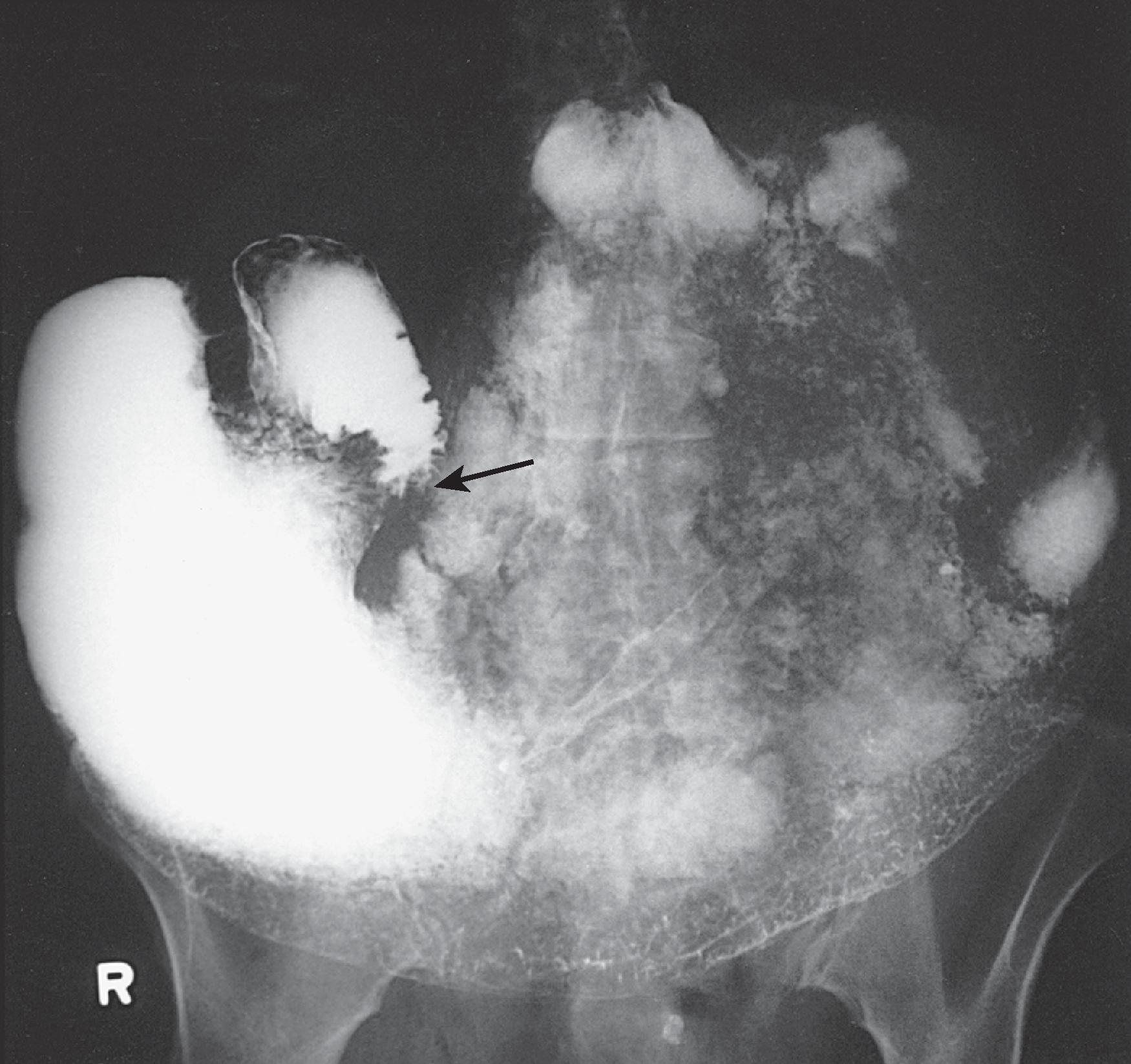 Fig. 21.9, Duodenal obstruction by retroperitoneal metastases.