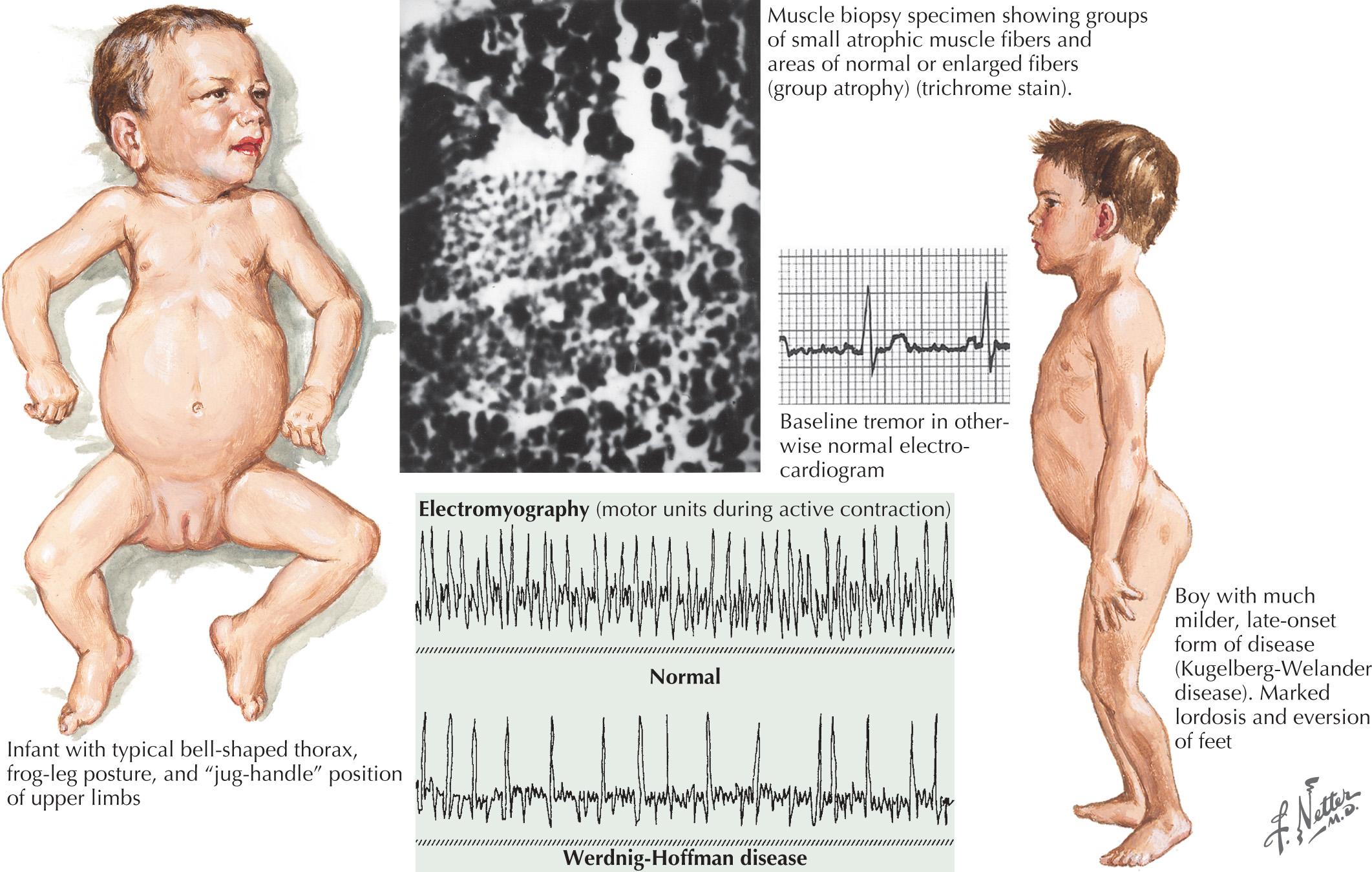 Fig. 63.1, Spinal Muscular Atrophy Type 1.