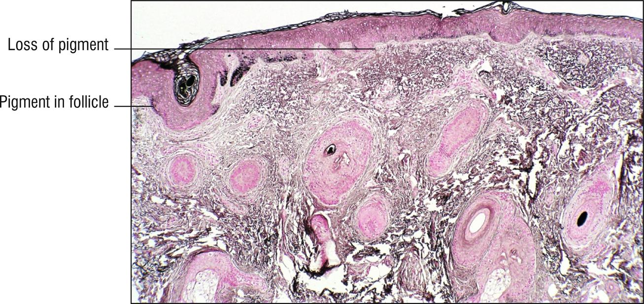Fig. 17.2, Vitiligo. The Fontana melanin stain shows repigmentation near follicle, compared to adjacent epidermis.