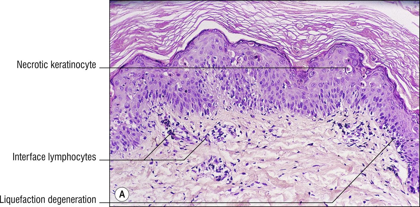 Fig. 17.3, A Graft-versus-host disease (acute).