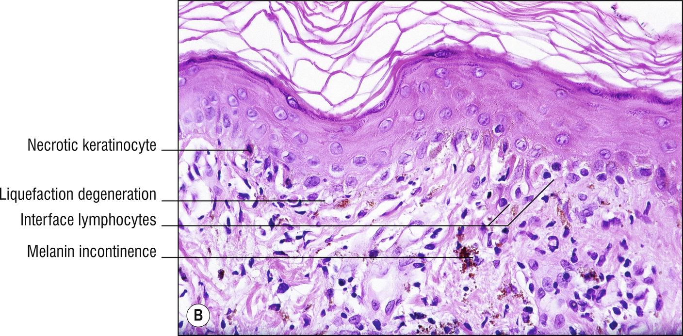 Fig. 17.3, B Graft-versus-host disease (chronic lichenoid).