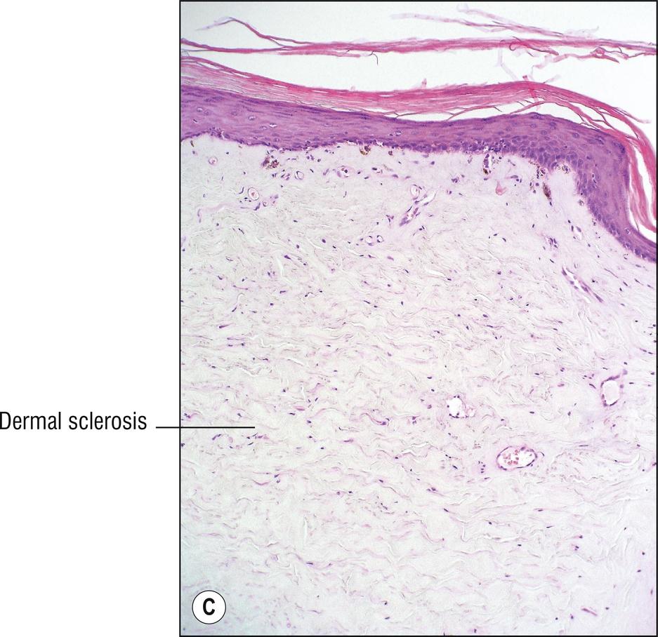 Fig. 17.3, C Sclerodermoid graft-versus-host disease.