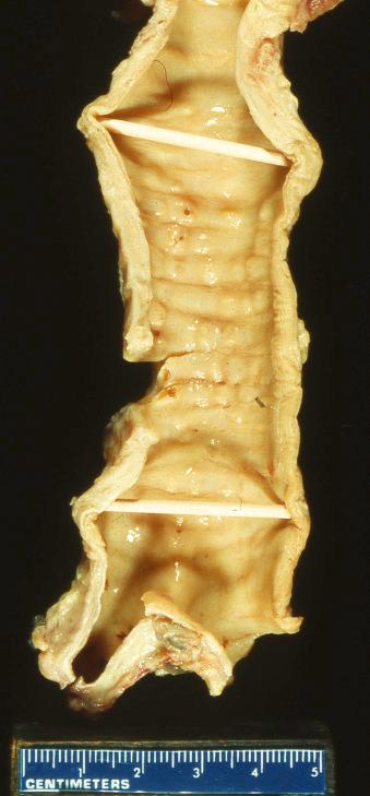 FIG. 25.1, Tracheobronchopathia osteochondroplastica. Trachea from postmortem examination specimen with “stalactite,” cobblestoning appearance in the airways.