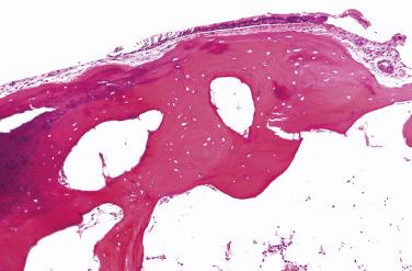 FIG. 25.2, Tracheobronchopathia osteochondroplastica. Bronchoscopic biopsy of a TBO lesion shows bone present beneath the respiratory mucosa.