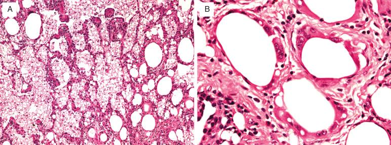 FIG. 25.3, Lipoid pneumonia. (A) The histologic picture includes abundant intraalveolar and interstitial foamy macrophages with variably sized vacuoles of lipid. (B) Giant cells form around the lipid vacuoles. Lymphocytes infiltrate the surrounding interstitium, and significant fibrosis may occur.