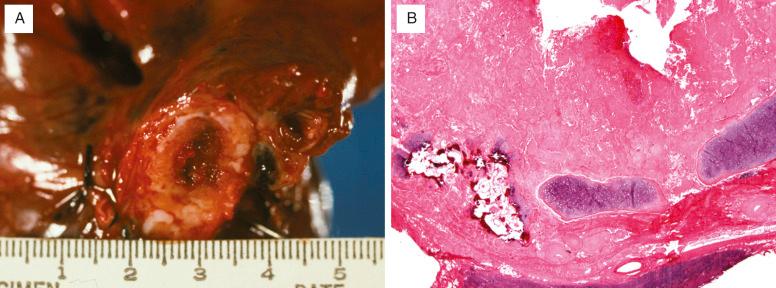 FIG. 25.4, Tracheobronchial amyloidosis. (A) A cross-section of bronchus involved by amyloidosis has a tan, firm, transmural thickening with a markedly narrowed airway lumen. (B) This cross-section of a cartilaginous airway with transmural eosinophilic amyloid deposition has calcification and ossification (lower left).