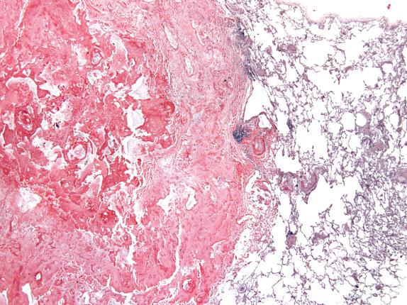 FIG. 25.5, Nodular amyloidosis. This dense, congophilic amyloid nodule has a well-circumscribed margin with adjacent normal alveoli (Congo red).