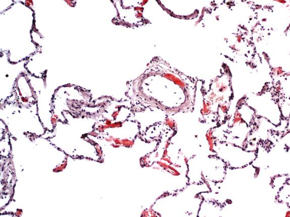 FIG. 25.7, Diffuse parenchymal amyloidosis. Congophilic amyloid deposition is present in alveolar walls and adjacent vessels (Congo red).