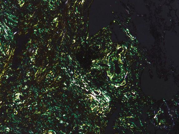 FIG. 25.8, Nodular amyloidosis. Amyloid stains with Congo red and has characteristic apple-green birefringence under polarized light.