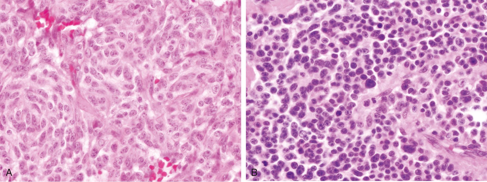 FIGURE 22-1, A, H&E stain of a typical carcinoid. B, H&E stain of an atypical carcinoid.