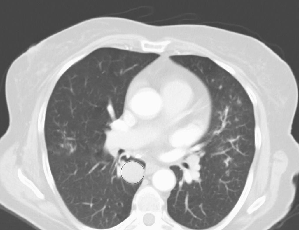 FIGURE 22-2, Chest CT scan of a typical carcinoid.