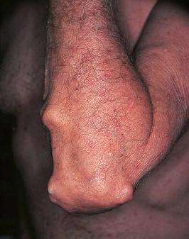 FIGURE 7-1, Rheumatoid nodules on the elbow.