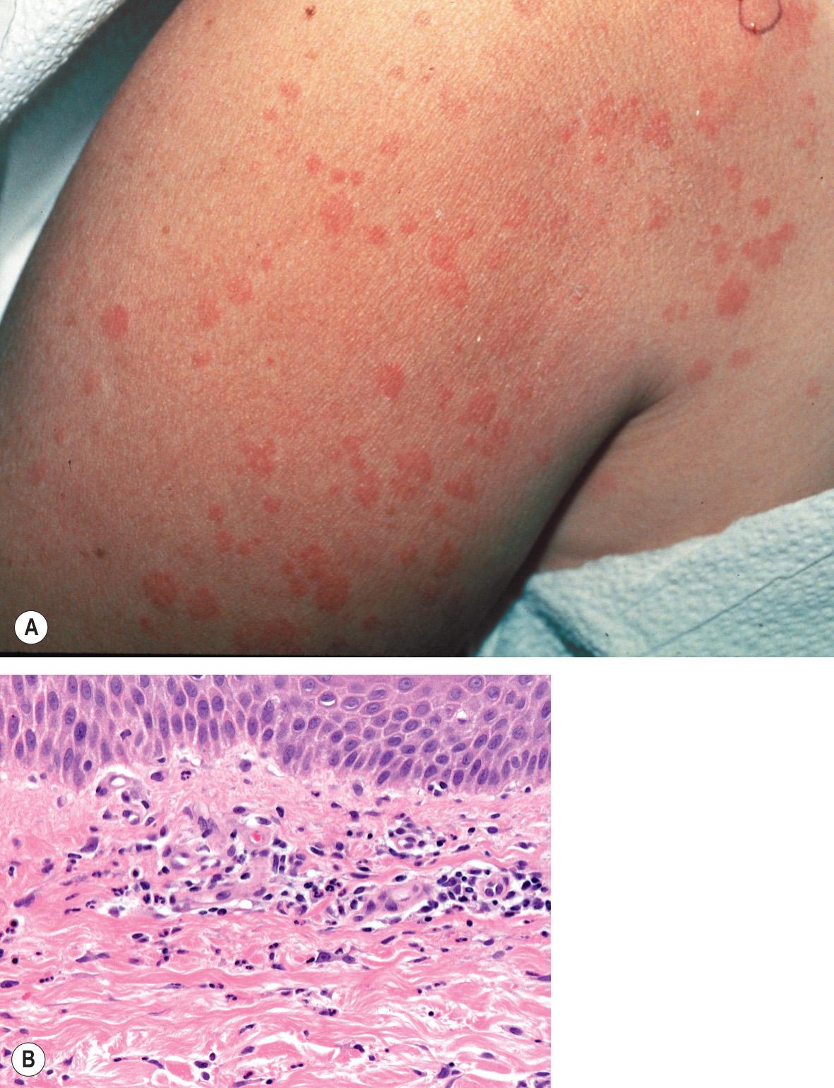 Fig. 45.2, Adult-onset Still disease.