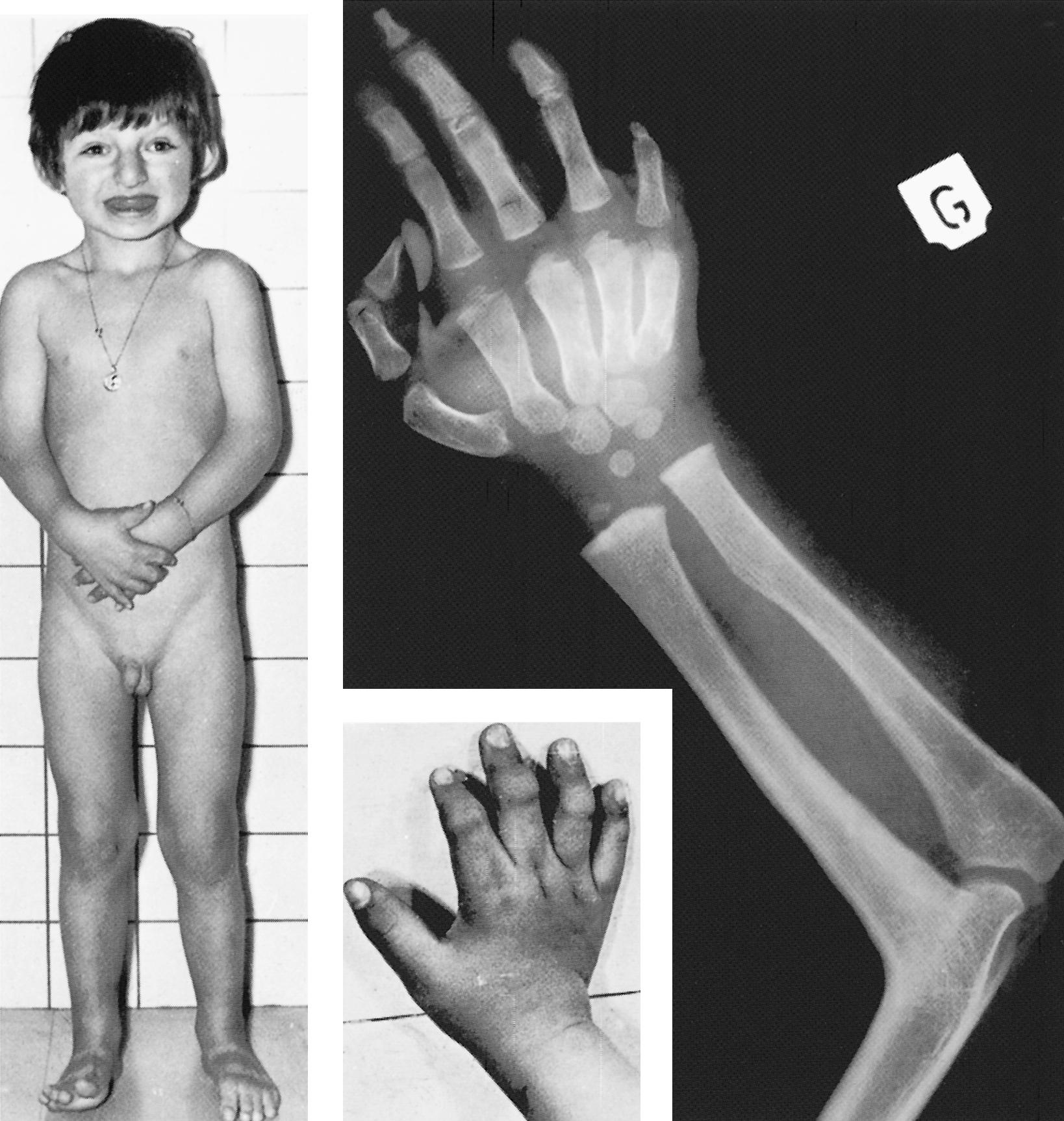 FIGURE 1, Multiple synostosis syndrome.