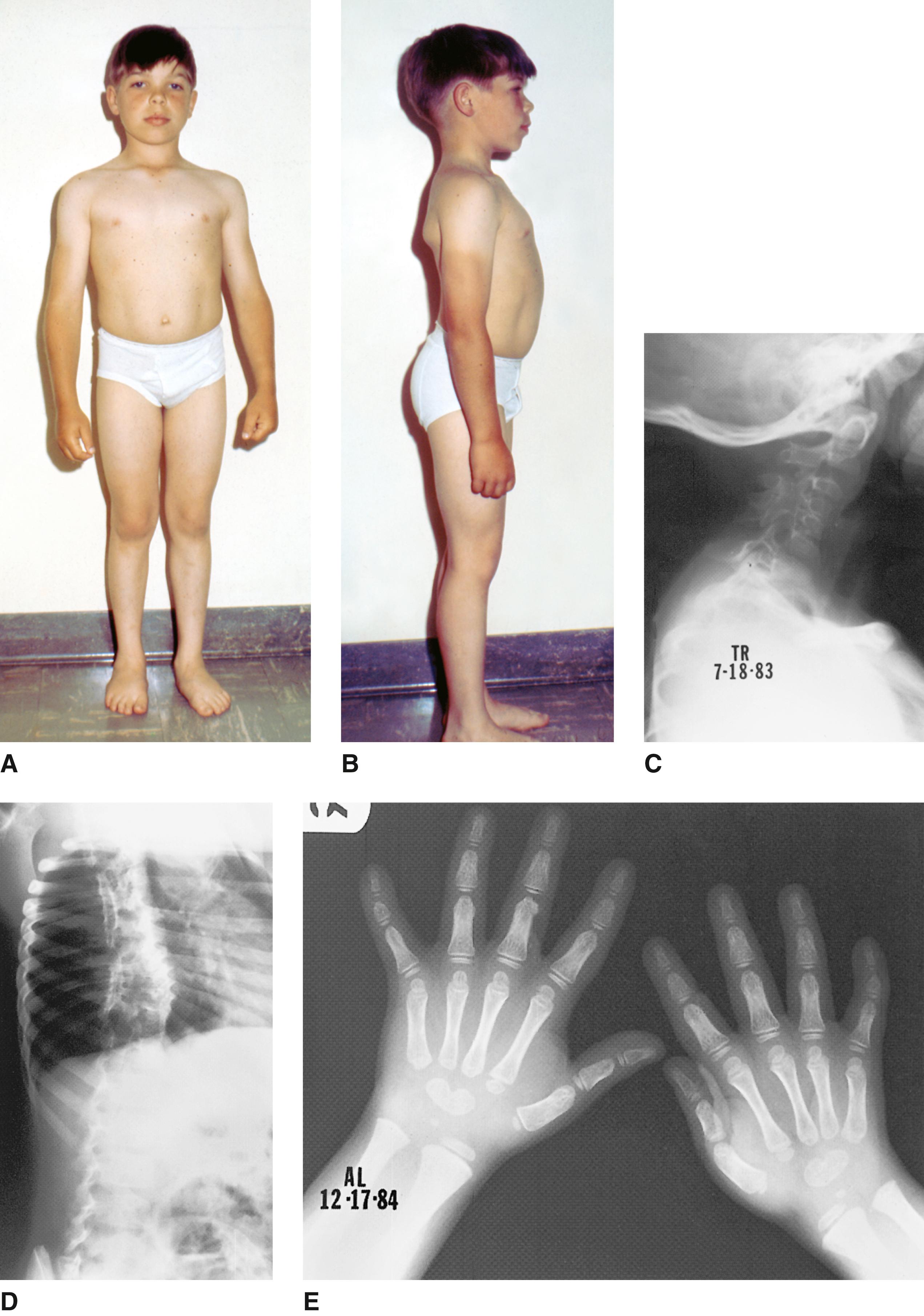 FIGURE 1, Spondylocarpotarsal synostosis syndrome.