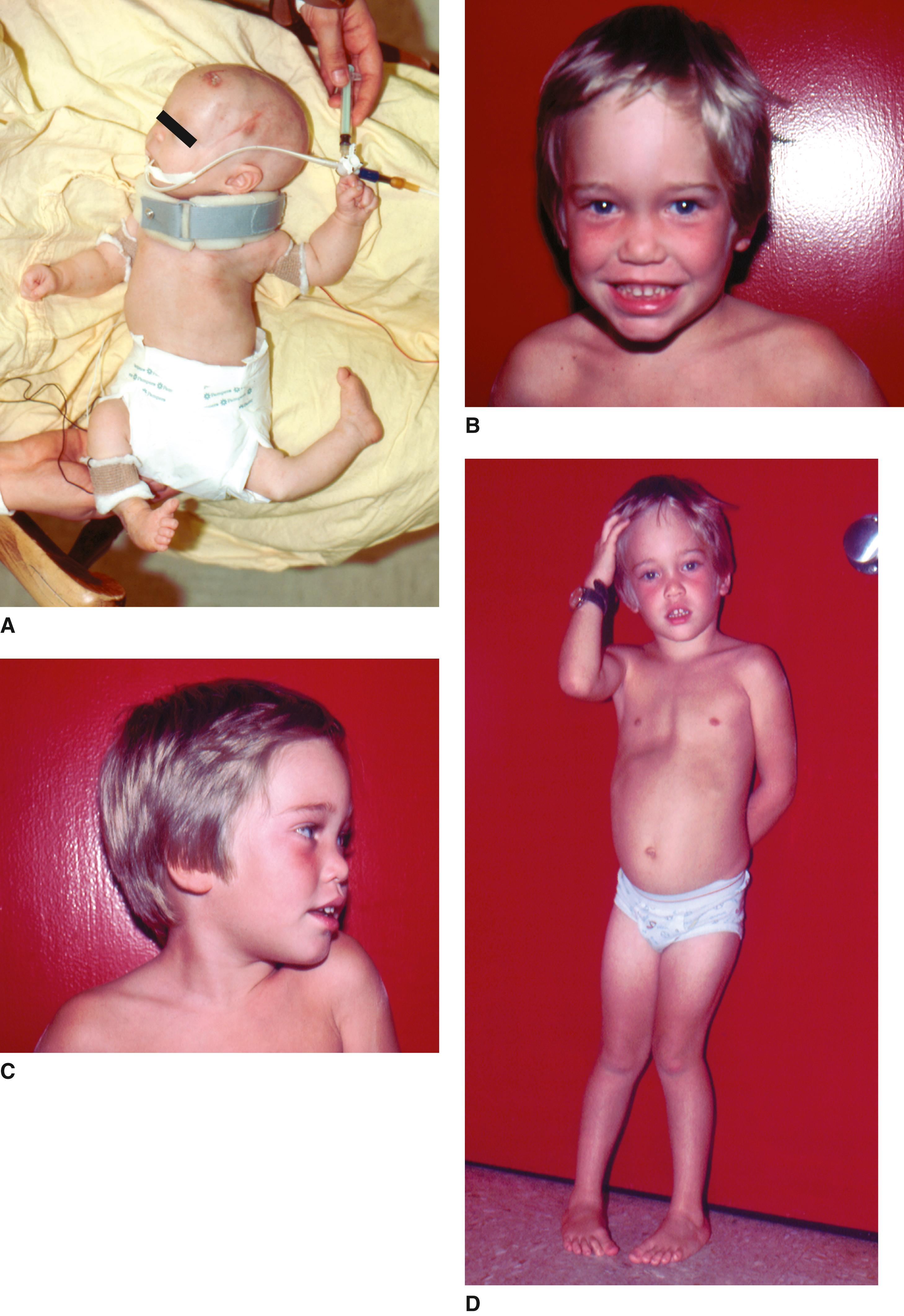 FIGURE 1, Larsen syndrome.