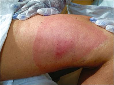 Figure 27-2, Erythema migrans.