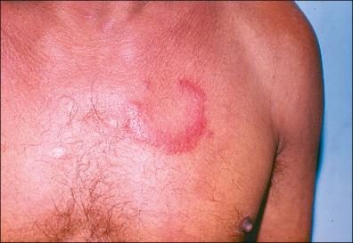 Figure 27-4, Erythema migrans: lesion with red outer rims and nearly complete clearing in the center.