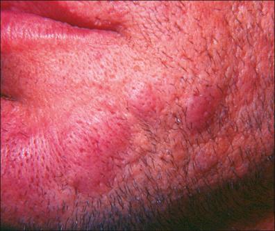 Figure 27-5, Borrelial lymphocytoma: bluish-red papules and nodules.