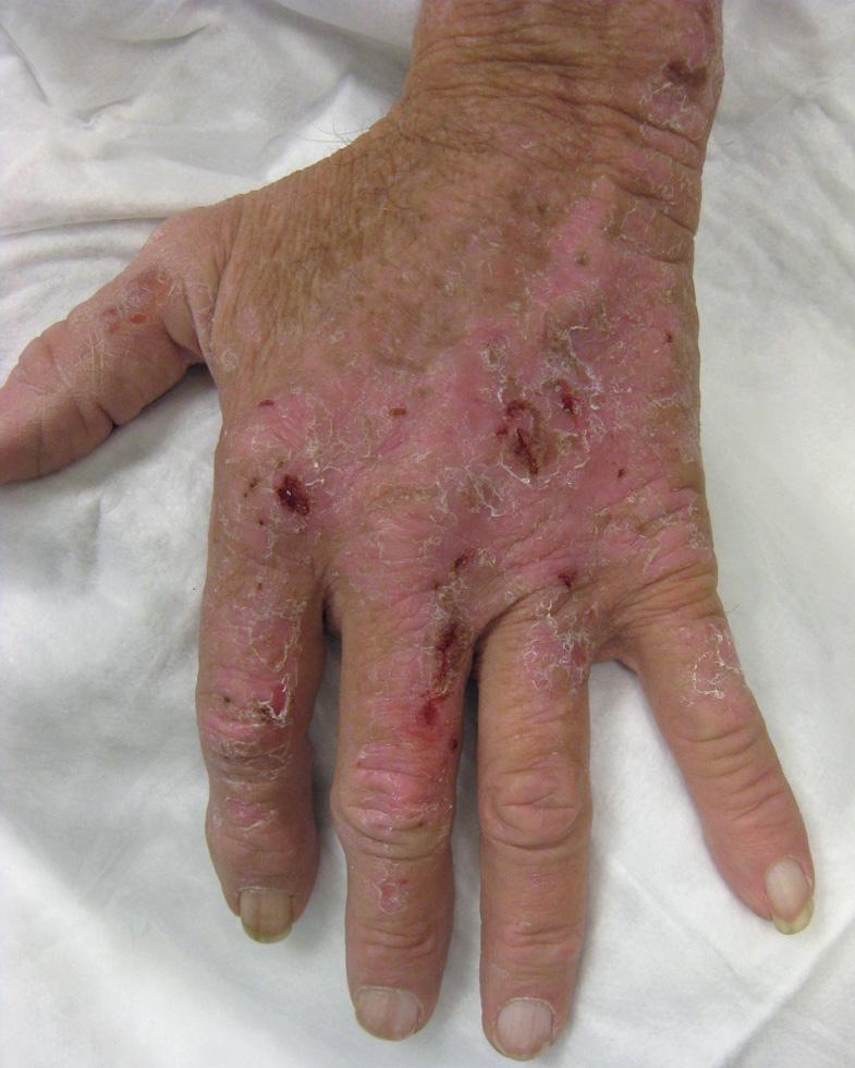 Fig. 130.1, Hydroxychloroquine-induced porphyria cutanea tarda (PCT).