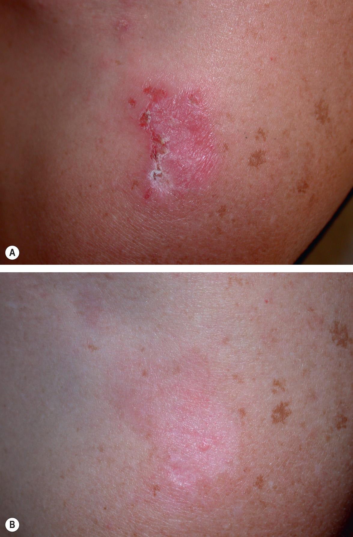 Fig. 129.6, Reaction to topical imiquimod treatment of an actinic keratosis.